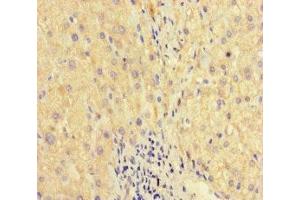 Immunohistochemistry of paraffin-embedded human liver cancer using ABIN7175867 at dilution of 1:100 (WAC anticorps  (AA 10-102))
