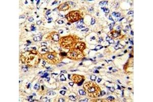 IHC analysis of FFPE human breast carcinoma with C5 antibody (C5 anticorps  (AA 253-281))