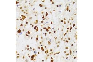 Immunohistochemistry of paraffin-embedded human brain astrocytoma using NASP Antibody.