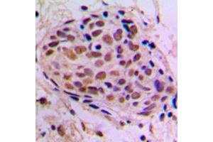 Immunohistochemical analysis of CREB staining in human breast cancer formalin fixed paraffin embedded tissue section.