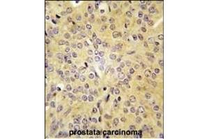 Formalin-fixed and paraffin-embedded human prostata carcinoma tissue reacted with LARS antibody (C-term) (ABIN391611 and ABIN2841532) , which was peroxidase-conjugated to the secondary antibody, followed by DAB staining. (LARS anticorps  (C-Term))