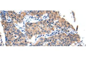 Immunohistochemistry of paraffin-embedded Human lung cancer tissue using PPBP Polyclonal Antibody at dilution of 1:35(x200) (CXCL7 anticorps)