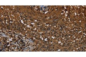 Immunohistochemistry of paraffin-embedded Human cervical cancer tissue using MYBBP1A Polyclonal Antibody at dilution 1:40 (MYBBP1A anticorps)