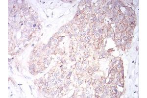 Immunohistochemical analysis of paraffin-embedded ovarian cancer tissues using SK2 mouse mAb with DAB staining. (KCNN2 anticorps  (AA 36-52))