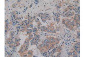 IHC-P analysis of Human Breast Cancer Tissue, with DAB staining. (AZGP1 anticorps)