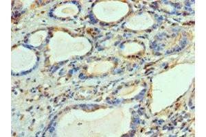 Immunohistochemistry of paraffin-embedded human prostate cancer using ABIN7144450 at dilution of 1:100 (BCL2L14 anticorps  (AA 1-327))