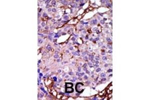 Formalin-fixed and paraffin-embedded human cancer tissue reacted with the primary antibody, which was peroxidase-conjugated to the secondary antibody, followed by DAB staining. (CASK anticorps  (C-Term))