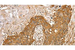 Immunohistochemistry of paraffin-embedded Human esophagus cancer tissue using RASSF9 Polyclonal Antibody at dilution 1:45 (RASSF9 anticorps)