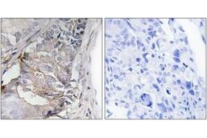 Immunohistochemistry analysis of paraffin-embedded human colon carcinoma, using PDGFR beta (Phospho-Tyr740) Antibody. (PDGFRB anticorps  (pTyr740))