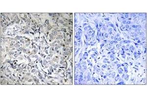 Immunohistochemistry analysis of paraffin-embedded human breast carcinoma, using NF-kappaB p65 (Phospho-Thr505) Antibody. (NF-kB p65 anticorps  (pThr505))