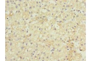 Immunohistochemistry of paraffin-embedded human liver cancer using ABIN7154545 at dilution of 1:100 (GDF2 anticorps  (AA 300-429))