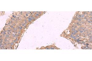 Immunohistochemistry of paraffin-embedded Human liver cancer tissue using KCNN3 Polyclonal Antibody at dilution of 1:40(x200) (KCNN3 anticorps)