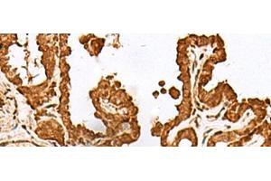 Immunohistochemistry of paraffin-embedded Human thyroid cancer tissue using FAM50A Polyclonal Antibody at dilution of 1:25(x200) (FAM50A anticorps)
