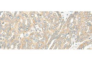 Immunohistochemistry of paraffin-embedded Human liver cancer tissue using ROM1 Polyclonal Antibody at dilution of 1:25(x200) (ROM1 anticorps)