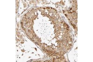 Immunohistochemical staining of human testis with SGSM1 polyclonal antibody  shows strong cytoplasmic positivity in cells in seminiferus ducts and moderate in Leydig cells at 1:10-1:20 dilution. (SGSM1 anticorps)