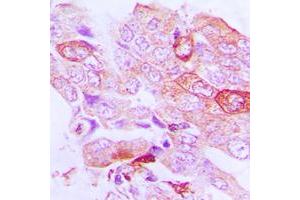 Immunohistochemical analysis of STK33 staining in human lung cancer formalin fixed paraffin embedded tissue section. (STK33 anticorps  (N-Term))