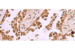 Immunohistochemistry of paraffin-embedded Human lung cancer tissue using IRX1 Polyclonal Antibody at dilution of 1:35(x200) (IRX1 anticorps)