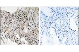 Immunohistochemistry analysis of paraffin-embedded human breast carcinoma tissue, using UEVLD Antibody.