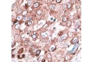 IHC analysis of FFPE hepatocarcinoma cancer tissue stained with the Bak antibody