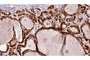 ABIN6267192 at 1/100 staining Human thyroid cancer tissue by IHC-P. (tau anticorps  (pSer202))