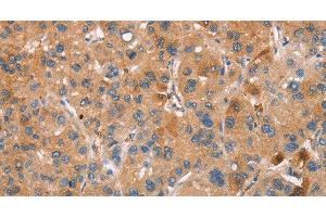 Immunohistochemistry of paraffin-embedded Human liver cancer using PLIN2 Polyclonal Antibody at dilution of 1:30 (ADRP anticorps)