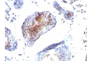 Formalin-fixed, paraffin-embedded human Testicular Carcinoma stained with FOXP3 Monoclonal Antibody (FXP3/197). (FOXP3 anticorps)