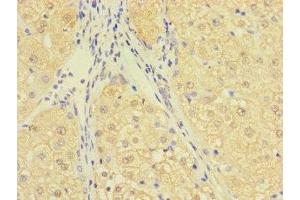 Immunohistochemistry of paraffin-embedded human liver cancer using ABIN7174695 at dilution of 1:100 (C1ORF111 anticorps  (AA 1-114))