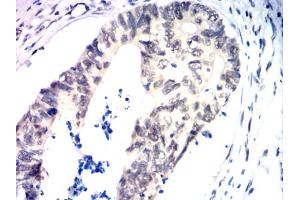 Immunohistochemical analysis of paraffin-embedded rectal cancer tissues using TDP43 mouse mAb with DAB staining.