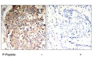 Immunohistochemical analysis of paraffin-embedded human breast carcinoma tissue using PTPN6 (phospho Y536) polyclonal antibody . (SHP1 anticorps  (pTyr536))