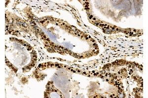 ABIN6263079 and ABIN6272518 at 1/100 staining Human ovarian cancer by IHC-P.