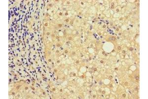 Immunohistochemistry of paraffin-embedded human liver cancer using ABIN7161926 at dilution of 1:100