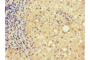 Immunohistochemistry of paraffin-embedded human liver cancer using ABIN7161926 at dilution of 1:100 (NRIP3 anticorps  (AA 1-241))