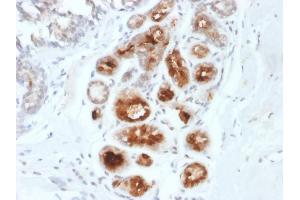 Formalin-fixed, paraffin-embedded human Breast Carcinoma stained with Mammaglobin-Monospecific Mouse Monoclonal Antibody (MGB1/2000). (Mammaglobin A anticorps)