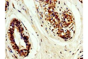 IHC image of ABIN7159489 diluted at 1:200 and staining in paraffin-embedded human breast cancer performed on a Leica BondTM system. (TIMP3 anticorps  (AA 1-184))