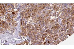 ABIN6273925 at 1/100 staining Human liver cancer tissue by IHC-P.
