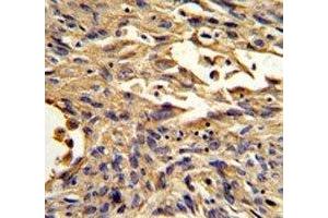 IHC analysis of FFPE human lung carcinoma stained with S100A10 antibody (S100A10 anticorps  (AA 12-40))