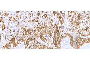 Immunohistochemistry of paraffin-embedded Human gastric cancer tissue using PHF6 Polyclonal Antibody at dilution of 1:85(x200) (PHF6 anticorps)