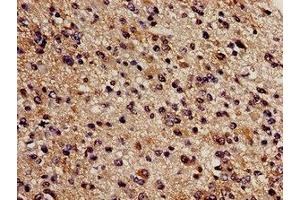 Immunohistochemistry analysis of human glioma using ABIN7148965 at dilution of 1:100