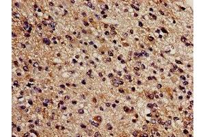 Immunohistochemistry analysis of human glioma using ABIN7148965 at dilution of 1:100 (CBS anticorps  (AA 1-413))