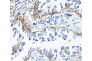 Immunohistochemistry of paraffin-embedded Human lung cancer using HLA-DRB3 Polyclonal Antibody at dilution of 1:100 (40x lens). (HLA-DRB3 anticorps)