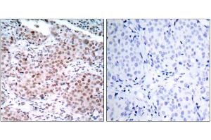 Immunohistochemical analysis of paraffin-embedded human breast carcinoma tissue using Estrogen Receptor-α (phospho-Ser104) antibody (E011070). (Estrogen Receptor alpha anticorps  (pSer104))