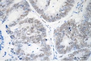 Immunohistochemistry was performed on paraffin-embedded human sigmoid colon carcinoma using EHMT2 antibody (ABIN7797609), 1:200). (Recombinant EHMT2 anticorps)