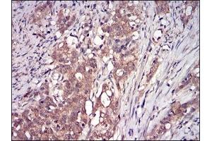 Immunohistochemical analysis of paraffin-embedded human cervical cancer tissues using DDIT3 mouse mAb with DAB staining. (DDIT3 anticorps  (AA 87-192))