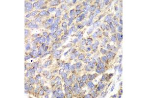 Immunohistochemistry of paraffin-embedded human esophageal cancer using ACY1 antibody at dilution of 1:100 (x40 lens). (Aminoacylase 1 anticorps)