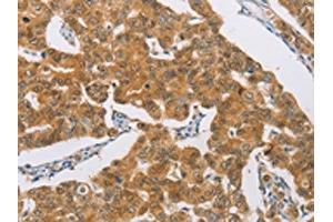 The image on the left is immunohistochemistry of paraffin-embedded Human breast cancer tissue using ABIN7189712(AGAP2 Antibody) at dilution 1/30, on the right is treated with synthetic peptide. (AGAP2 anticorps)