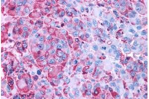 Anti-GPR50 antibody IHC staining of human melanoma.