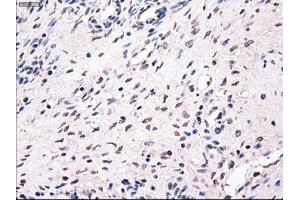 Immunohistochemical staining of paraffin-embedded Adenocarcinoma of breast tissue using anti-MRI1 mouse monoclonal antibody. (MRI1 anticorps)