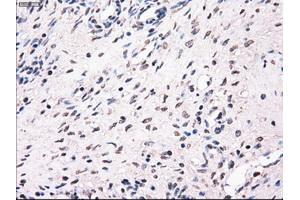 Immunohistochemical staining of paraffin-embedded Adenocarcinoma of breast tissue using anti-MRI1 mouse monoclonal antibody. (MRI1 anticorps)