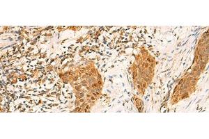Immunohistochemistry of paraffin-embedded Human esophagus cancer tissue using GINS2 Polyclonal Antibody at dilution of 1:50(x200) (GINS2 anticorps)