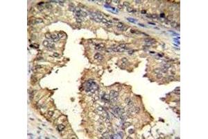 IHC testing of PRMT4 antibody and FFPE human prostate carcinoma.